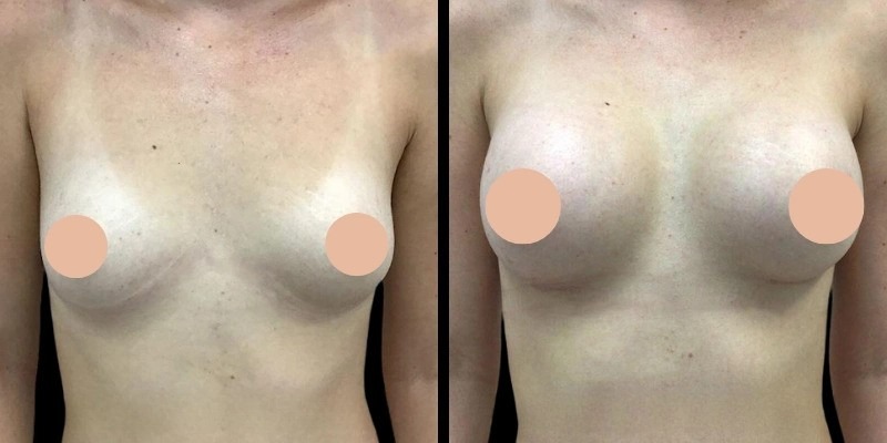 Best Doctors in Dubai for Achieving Balanced Breast Augmentation Results