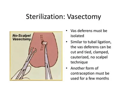 No Scalpel Vasectomy: Recovery in Simple Steps