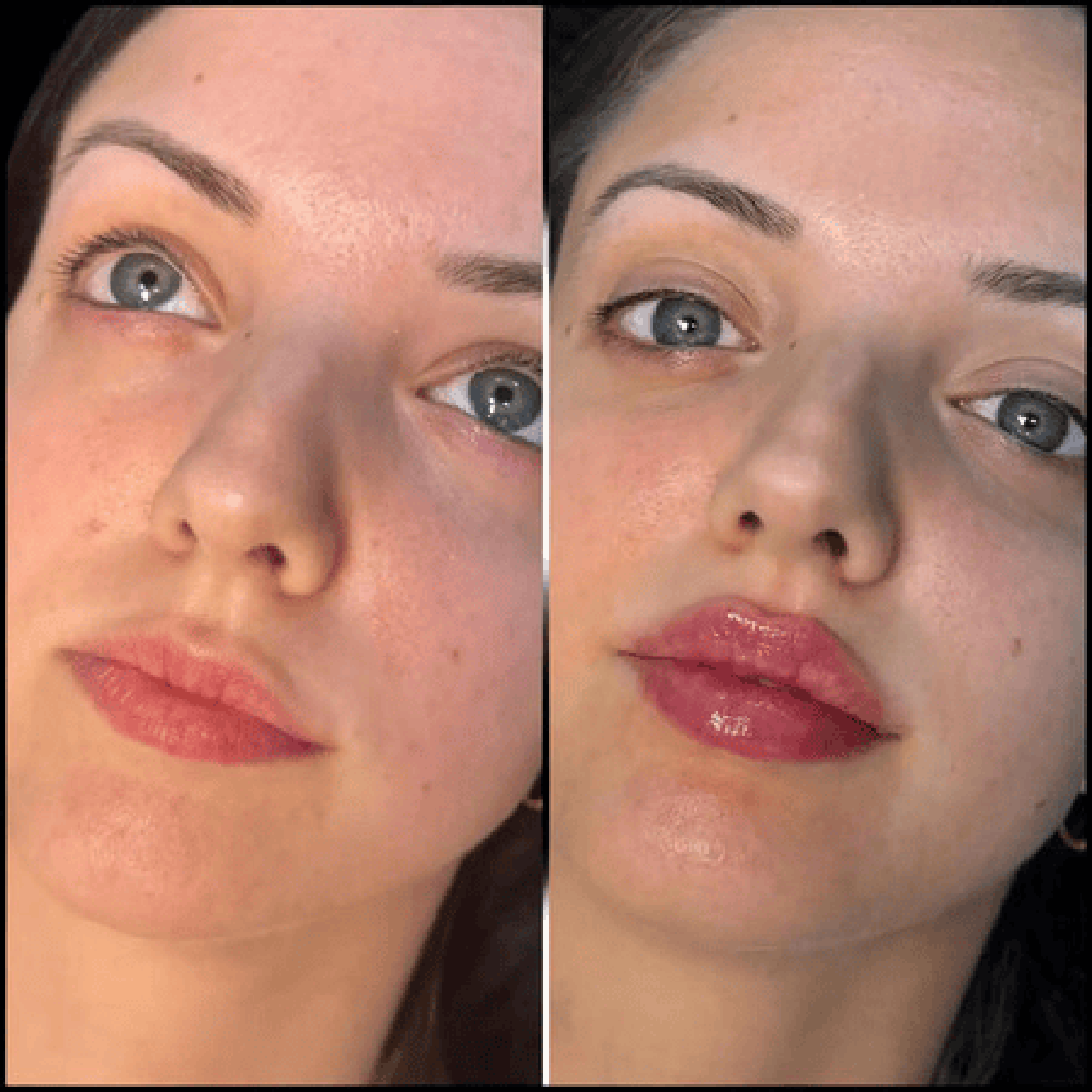 The Art of Beauty at the Best Doctors in dubai for Fillers