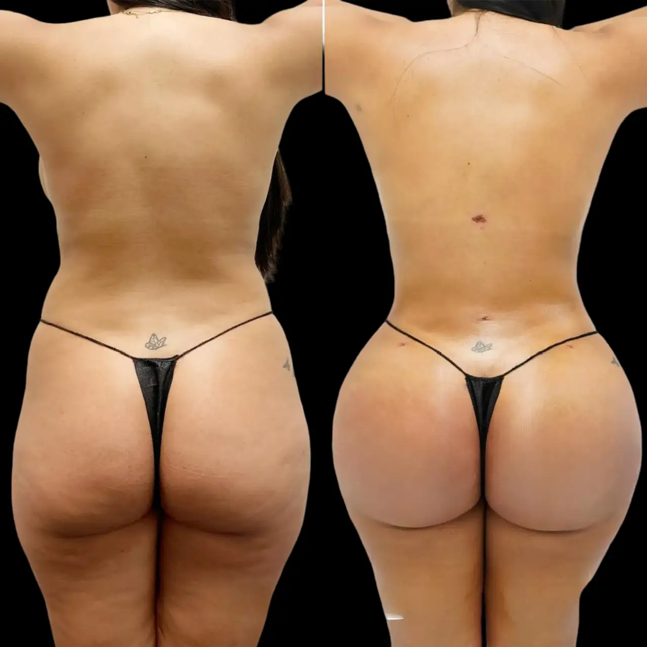 Fat Transfer Surgery in Dubai: Maintaining Results After Treatment
