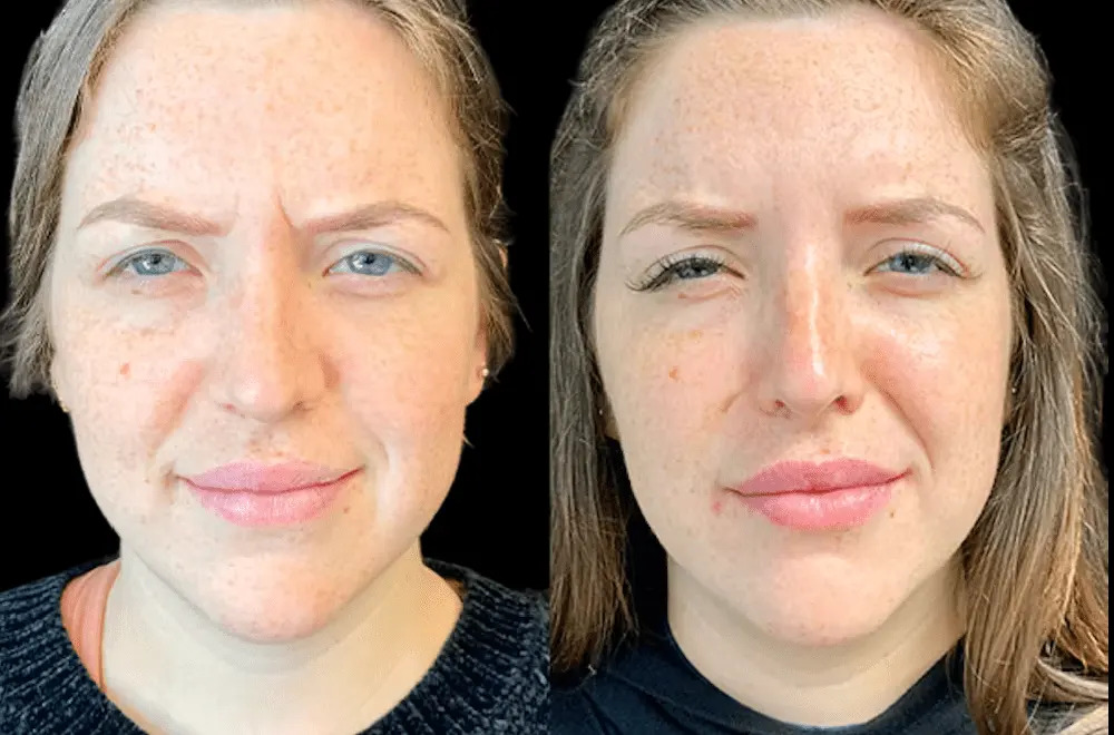 Botox Treatment in Dubai: Effective Solutions for Frown Lines