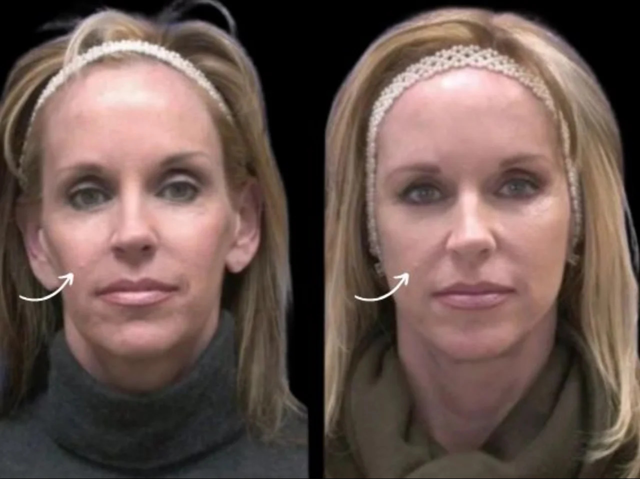 Sculptra Treatments in Dubai: Building a Long-Term Care Strategy