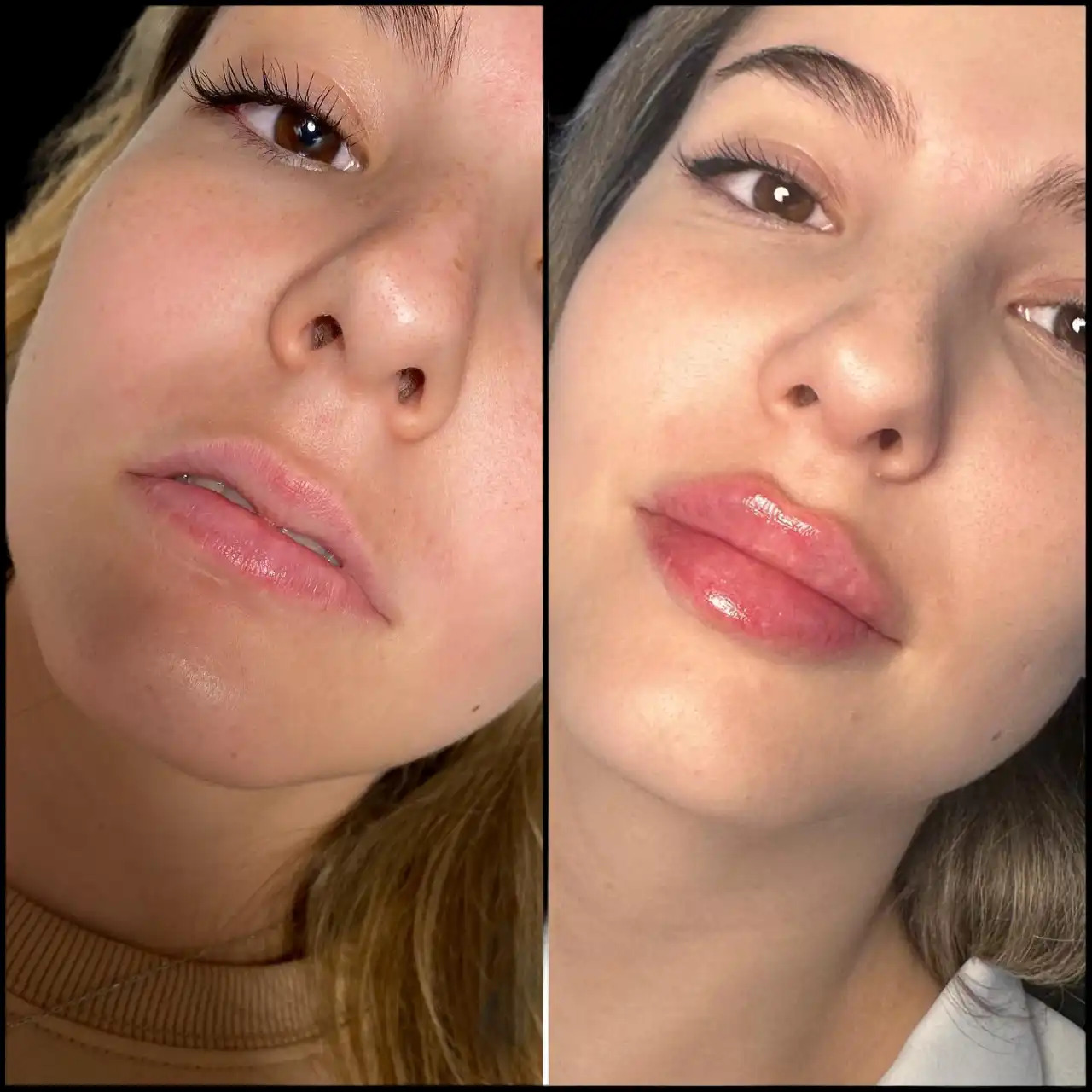 Top Best Plastic Surgeons in dubai for Lip Enhancement with Dermal Fillers