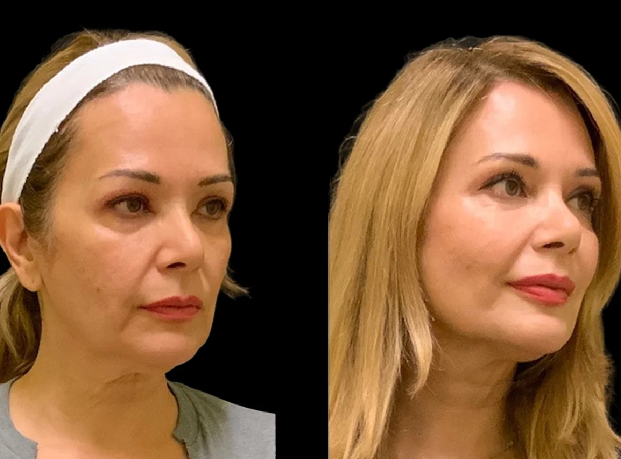 Cheek Fillers Injection Guide by Best Plastic Surgeons in Dubai
