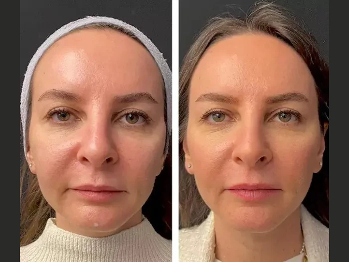 Mesotherapy Treatments in Dubai for Enlarged Pores