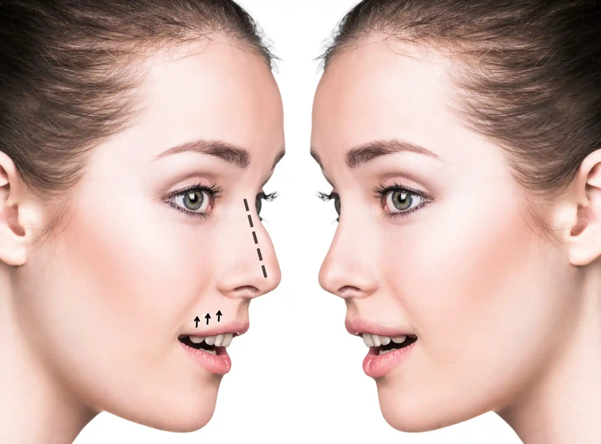 Can Best Rhinoplasty Surgeons in Dubai Refine Bulbous Nose Tips?
