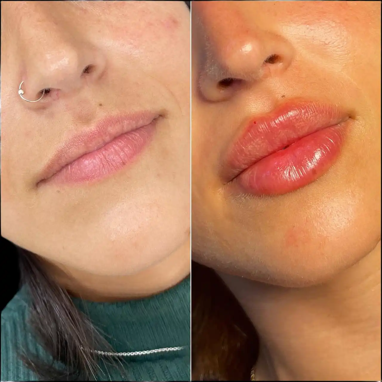 How to Choose the Best Plastic Surgeons in Dubai for Fillers Treatments