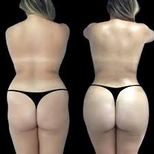 Butt Fat transfer surgery in dubai: Understanding the Importance of Follow-Up Visits