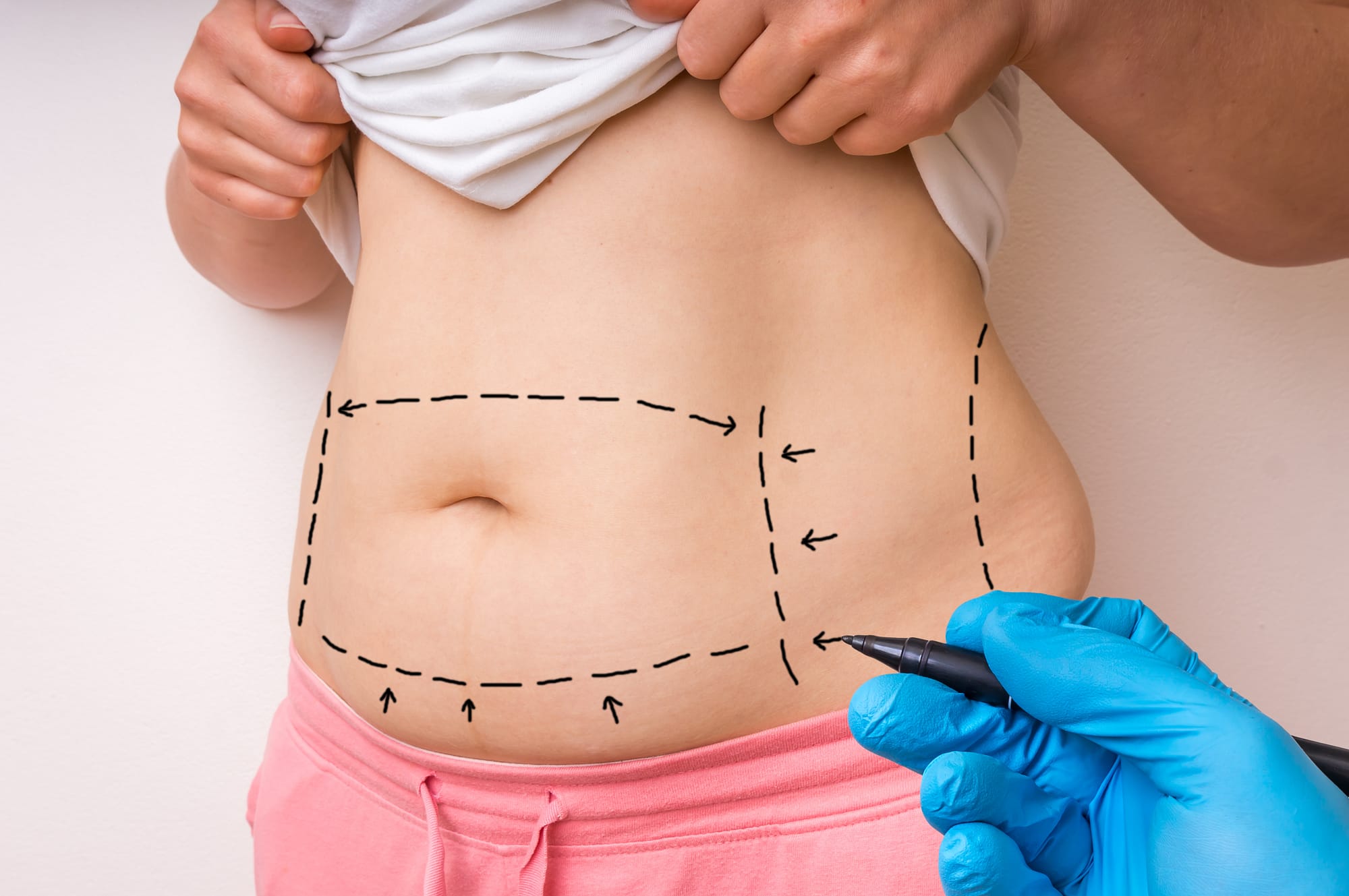 Mommy Makeover in Dubai: Choosing the Right Surgeon