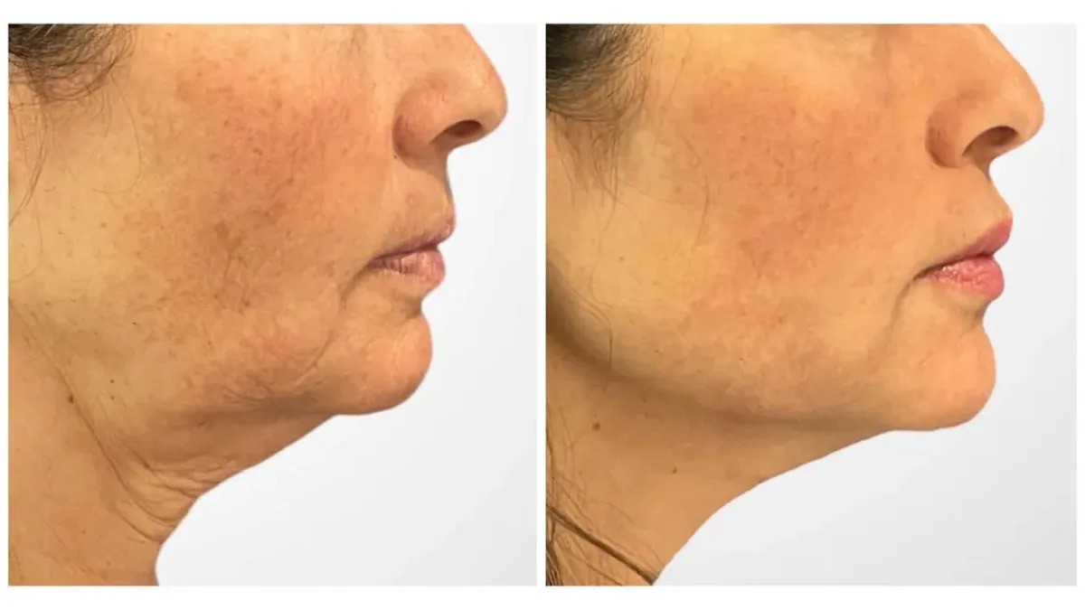 Thread Lift Treatment in Dubai Enhancing Beauty With Subtle Rejuvenation